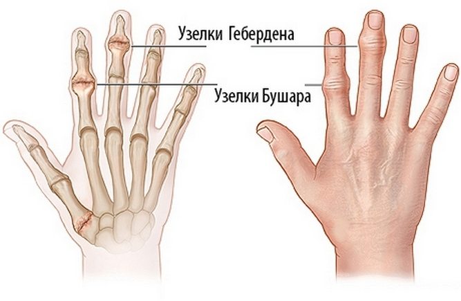 Узелки Гебердена и Бушара на пальцах Узелки Гебердена и Бушара