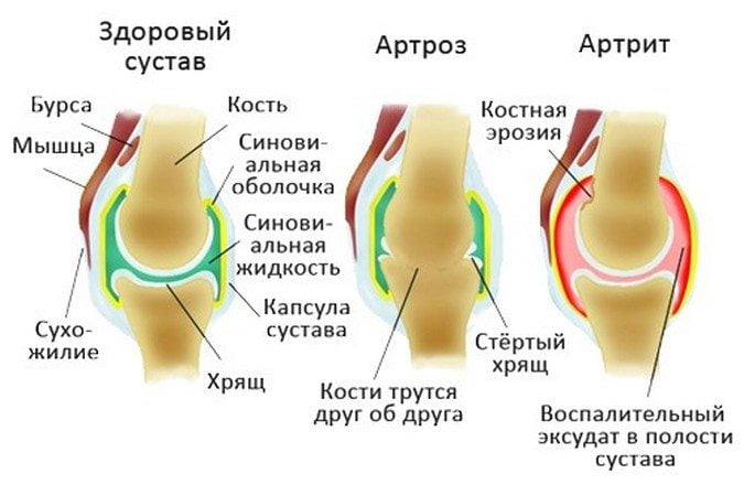 Здоровый и пораженные артритом и артрозом суставы Разница артроза от артрита
