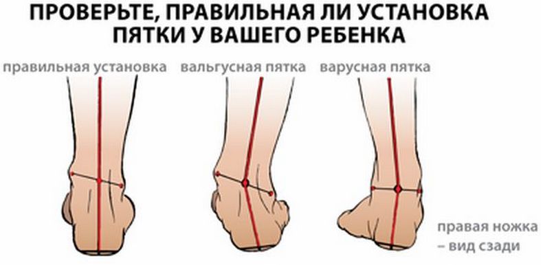 Установка стоп у ребенка Установка стоп