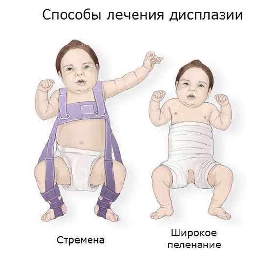 Способы лечения дисплазии тазобедренного сустава Лечение дисплазии ТБС