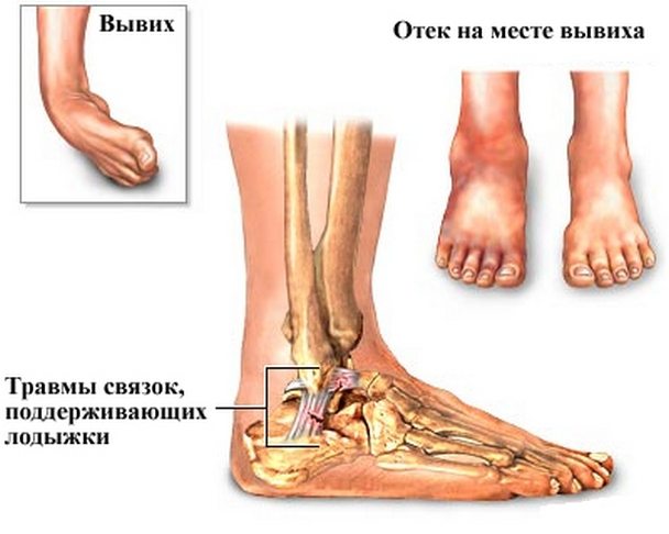 Вывих голеностопного сустава Вывих голеностопа