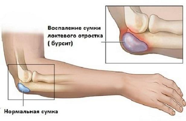 Отличие нормальной сумки сустава от воспаленной (бурсита) Бурсит
