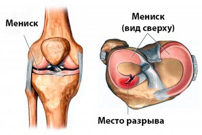 Разрыв наружнего мениска коленного сустава Разрыв мениска
