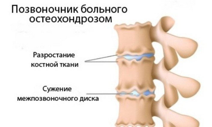 Позвоночник пораженный остеохондрозом Остеохондроз позвоночника