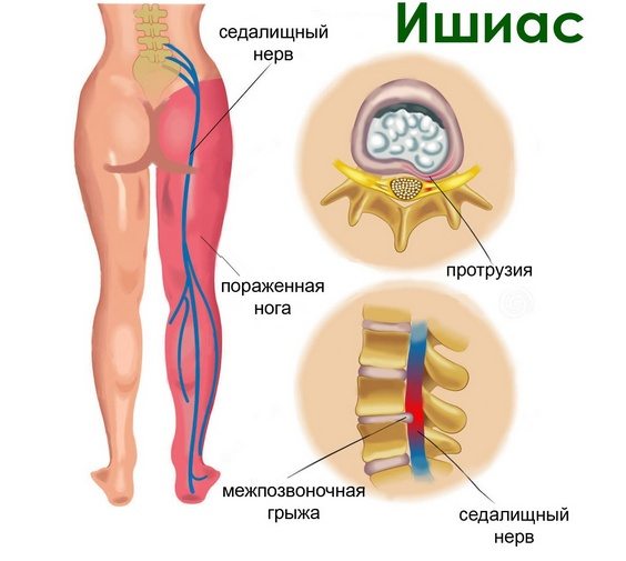 Ишиас - отдача болей в ногу или спину Ишиас